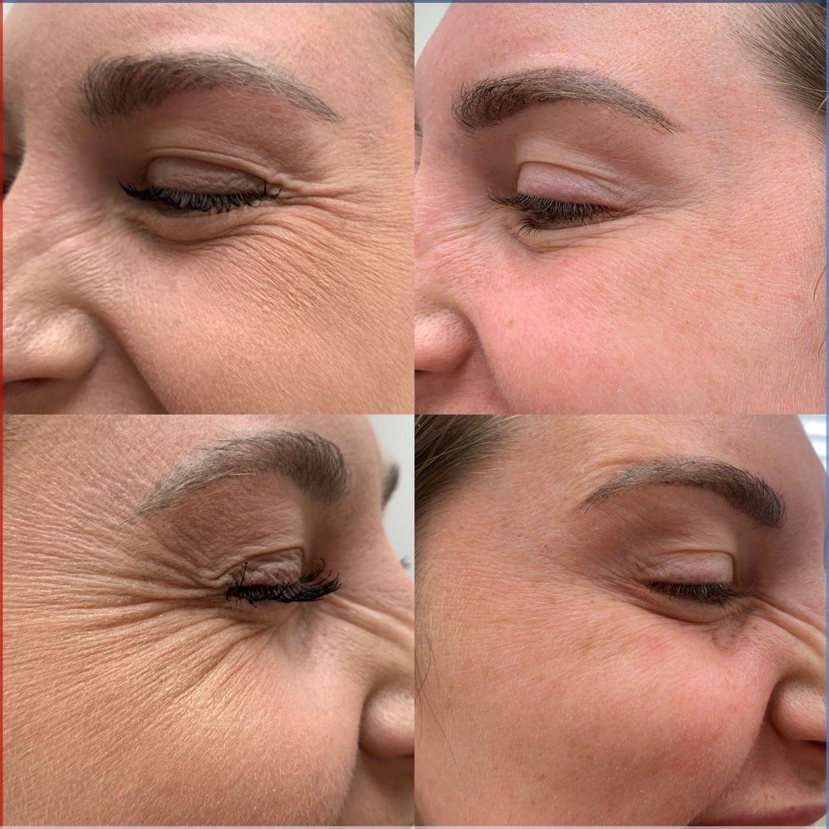 PDO Threads – Skin Rejuvenation Treatment