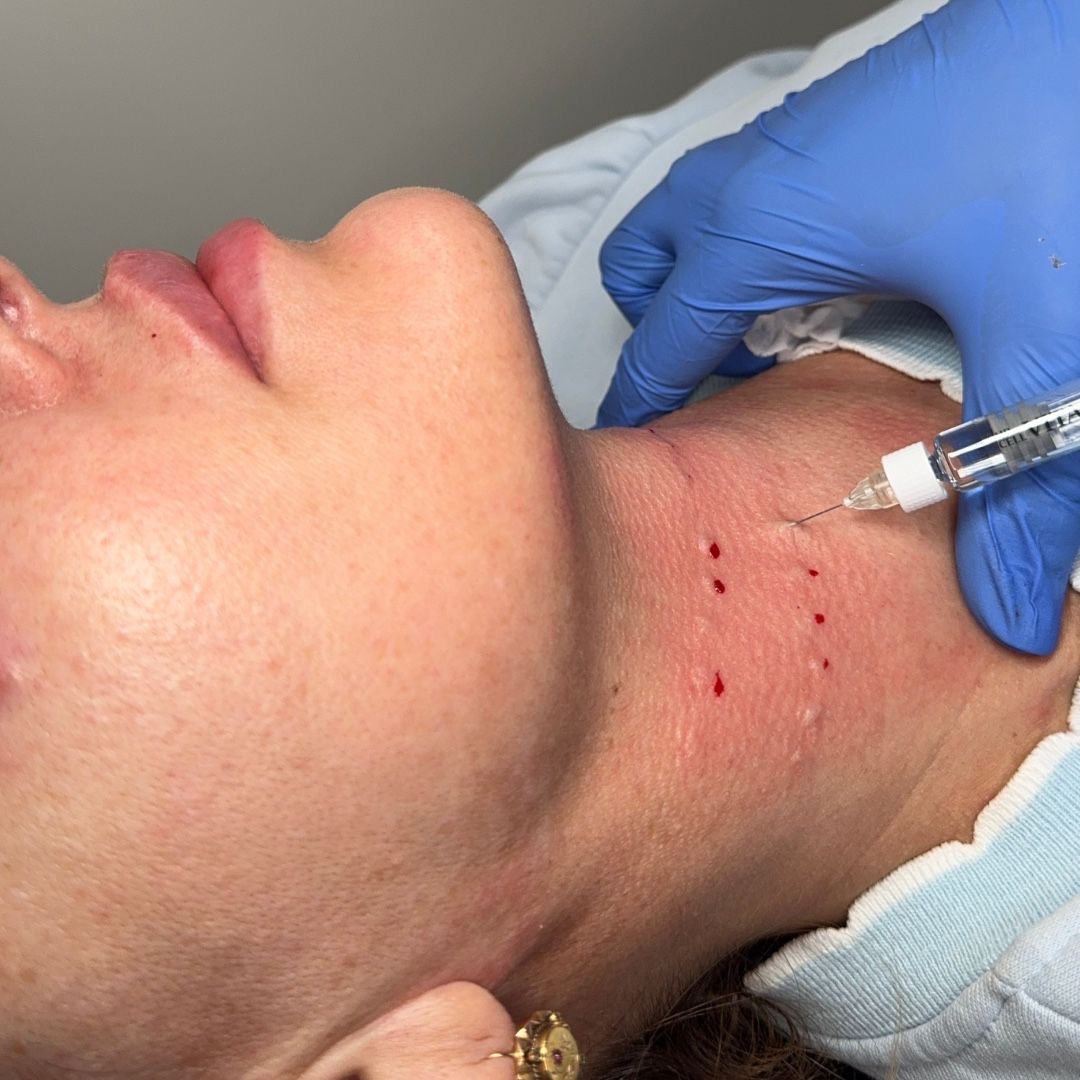 Mesotherapy