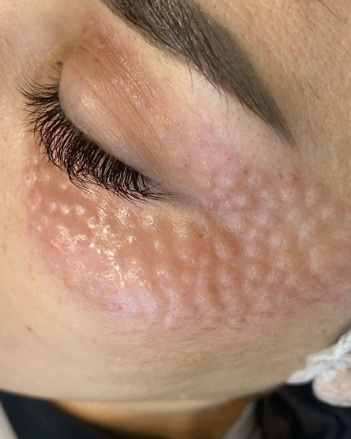 Mesotherapy
