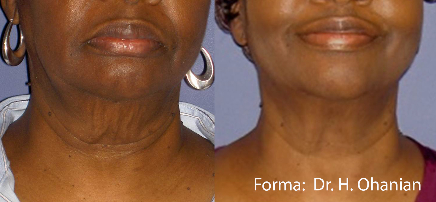 FORMA by InMode