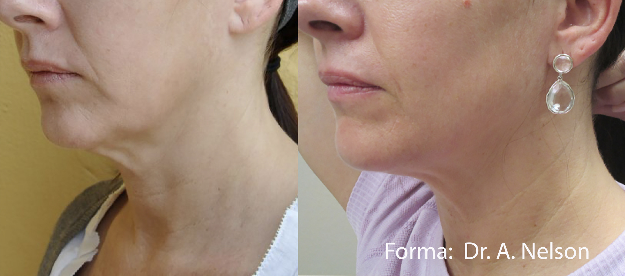 FORMA by InMode