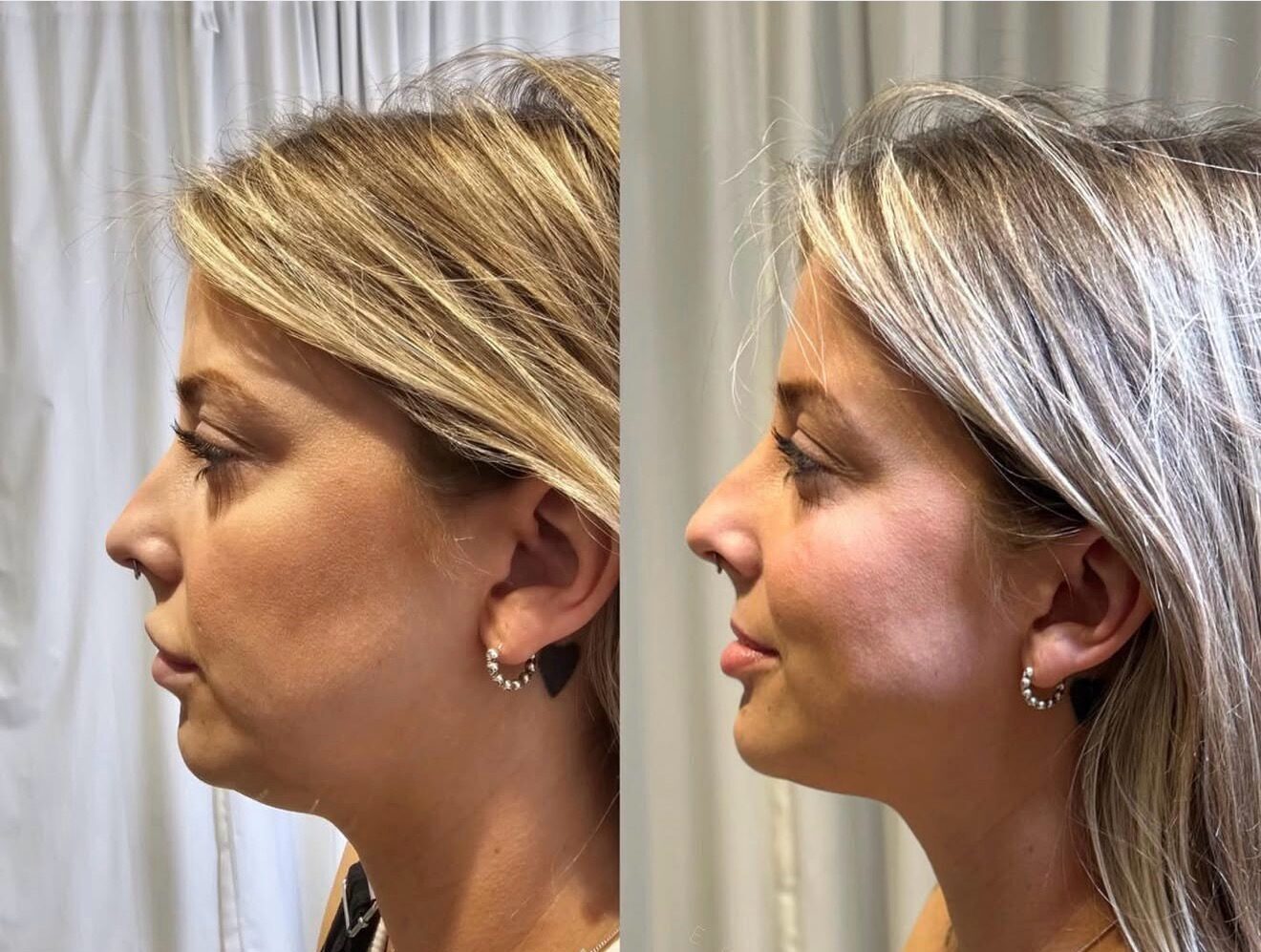 Fat Dissolving Injections