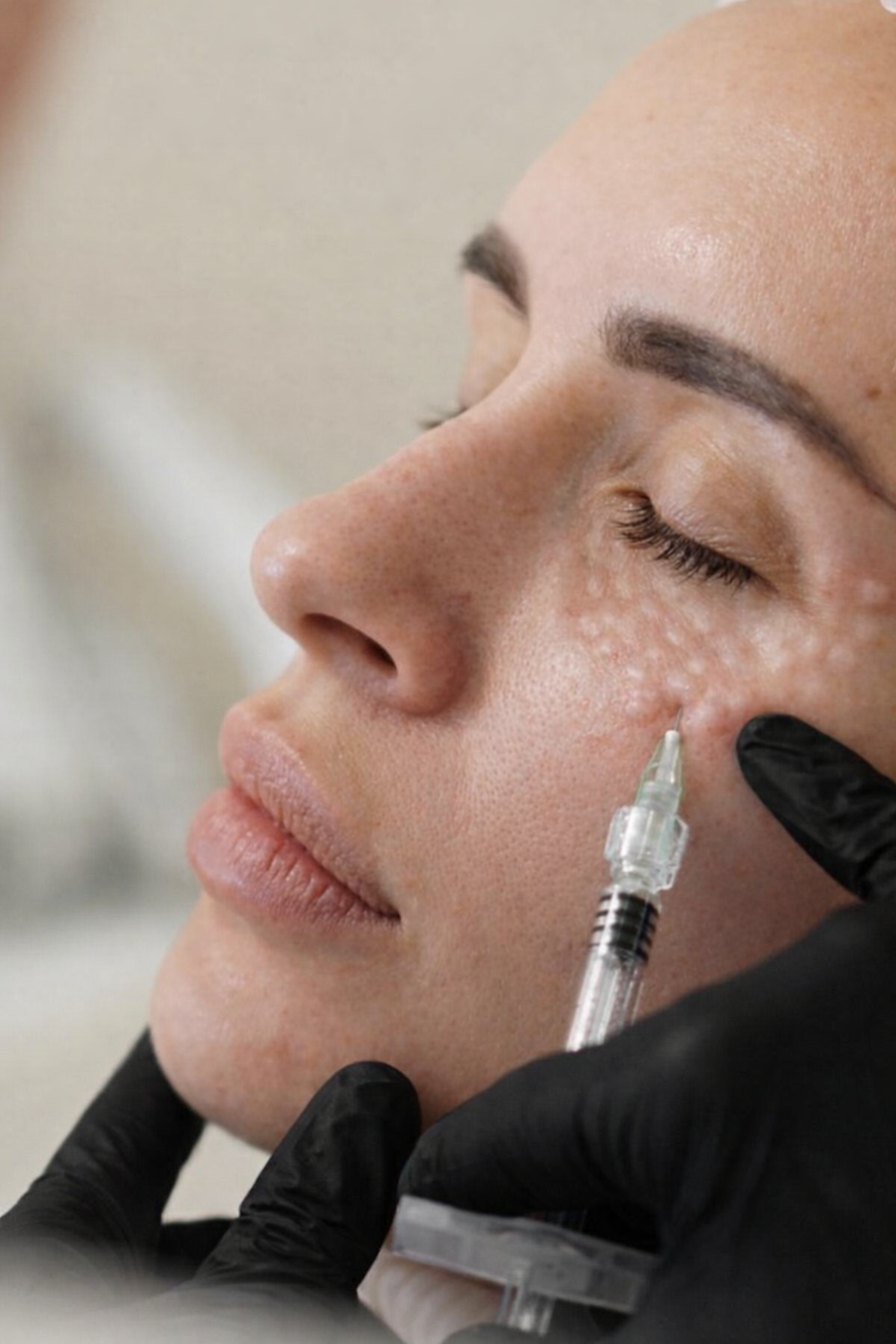 Mesotherapy